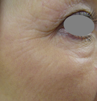 After Skin Resurfacing