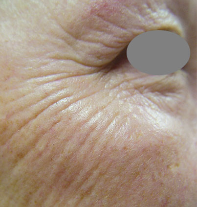 Before Skin Resurfacing