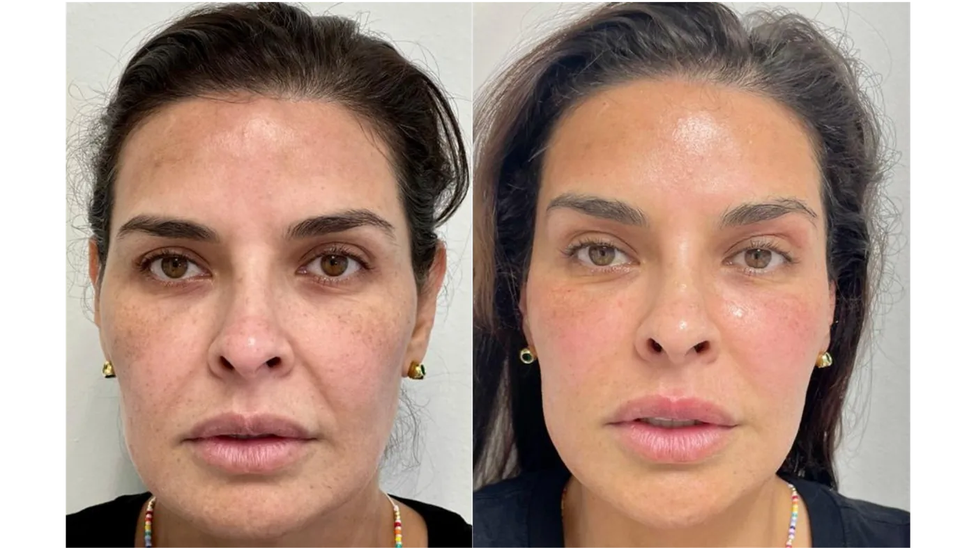 Fotona4D facial lift