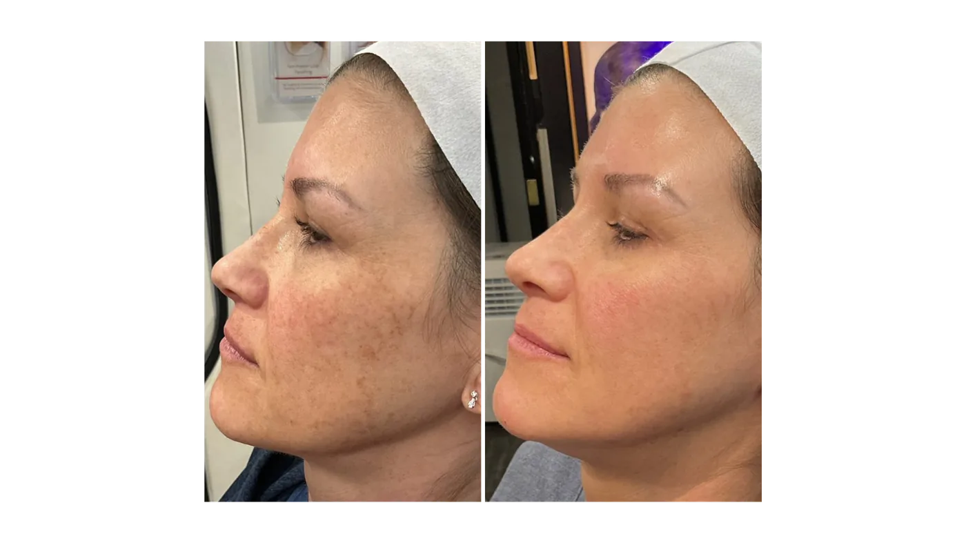 Skin resurfacing treatment