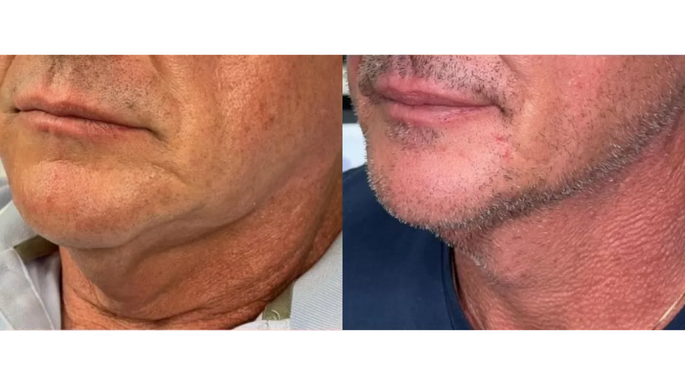 TightSculpting®