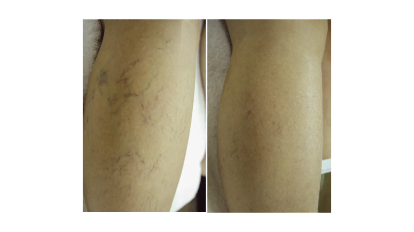 Vascular Lesions